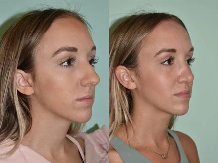 Rhinoplasty Before and After Pictures Tampa, FL