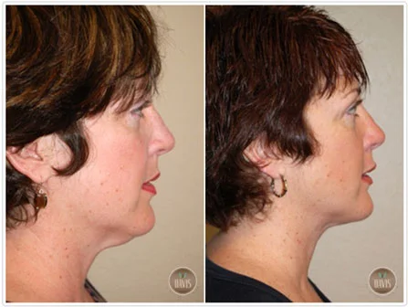 Neck Lift Before and After Pictures Tampa, FL